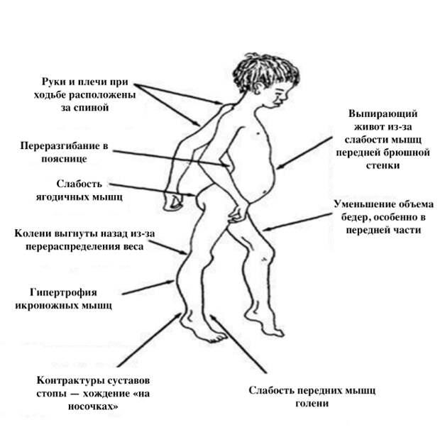 Ранние клинические проявления миодистрофии Дюшенна (DOI:10.5075/epfl-thesis-9104 с изм.) Ранние клинические проявления миодистрофии Дюшенна (DOI:10.5075/epfl-thesis-9104 с изм.)