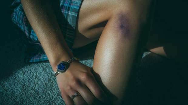 Терапевт назвал причины частого появления синяков на теле