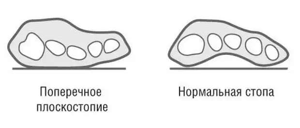 Поперечное плоскостопие фото лечение