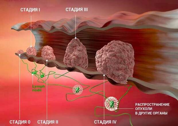 7 альтернатив колоноскопии для обнаружения рака прямой кишки