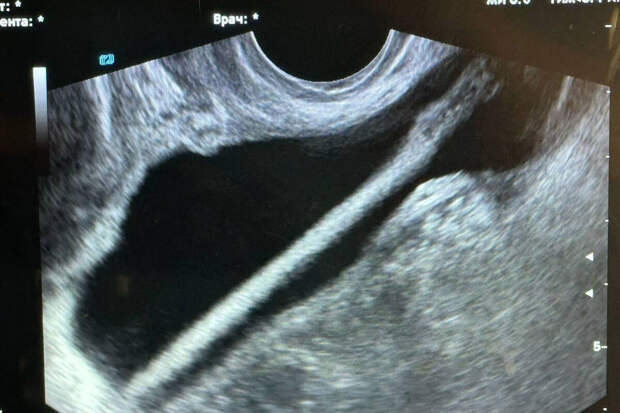 В Подмосковье у женщины из мочевого пузыря достали карандаш