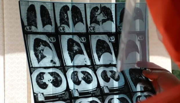 В США зафиксирована вспышка опасного аденовируса