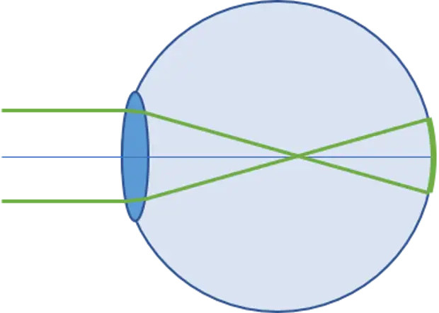 Схема хода лучей в глазе при близорукости