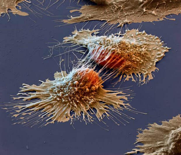 Снимок раковых клеток под электронным микроскопом.