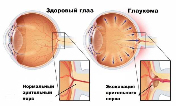 Кому грозит глаукома?