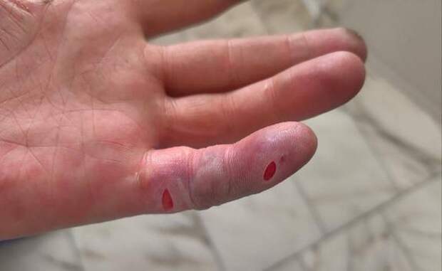 Врачи предупреждают: обмороженную часть тела нельзя растирать снегом