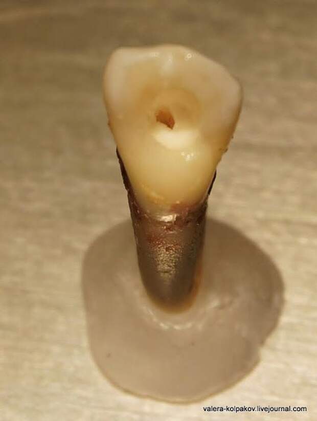 Как пломбируют корневые каналы в зубах как это сделано, пломба, зубы