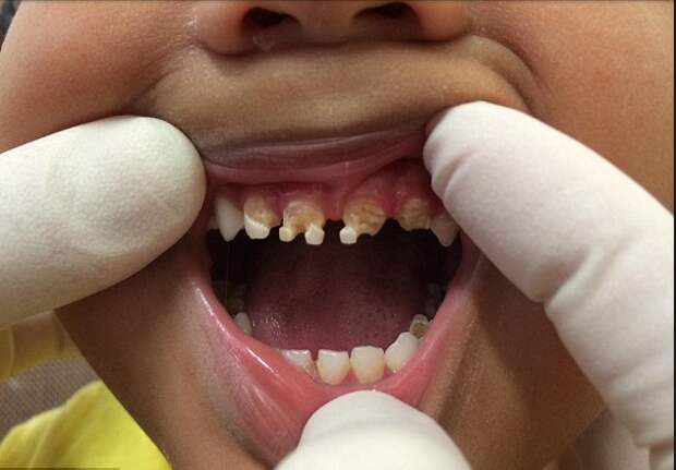 Этот стоматолог вырвал 11 зубов у маленького мальчика. Причина невероятна!