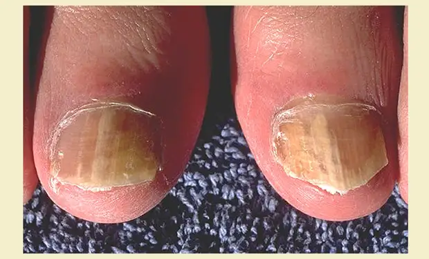 Стригущий лишай: грибок ногтей пальцев ног