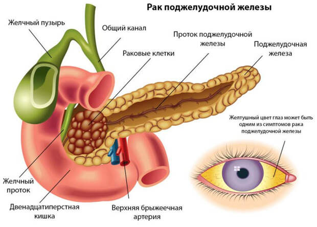 Рак поджелудочной железы: персонализированная мРНК-вакцина  новый шаг в лечении!