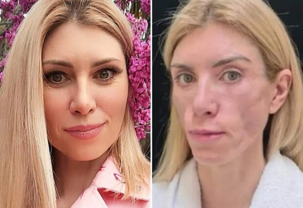 Изуродованная модель из Сочи выиграла у клиники 6,5 миллионов за неудачную операцию