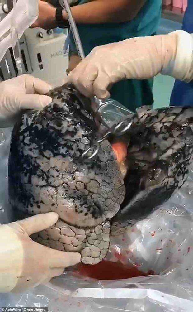 charcoaled lungs