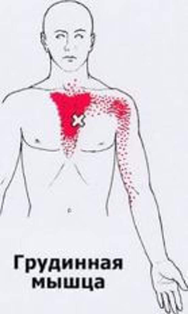 Карта точек боли в теле и точек напряжения мышц триггеры