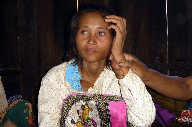 Найденная в джунглях: печальная история камбоджийской женщины-Маугли