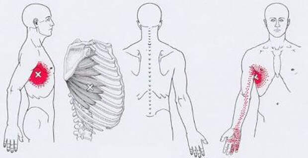 Карта точек боли в теле и точек напряжения мышц триггеры