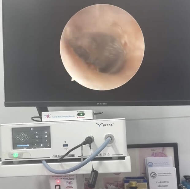 Насекомое поселилось в ухе россиянки во время отдыха в Таиланде