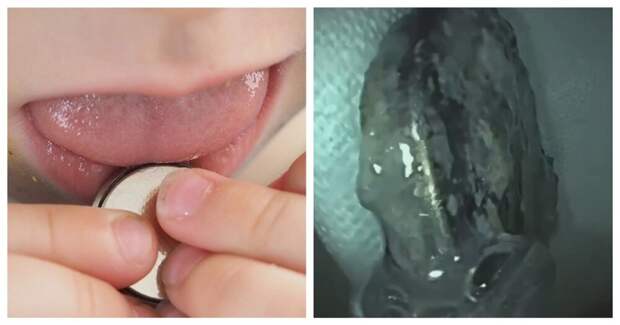 В Москве врачи спасли маленькую девочку,  проглотившую батарейку