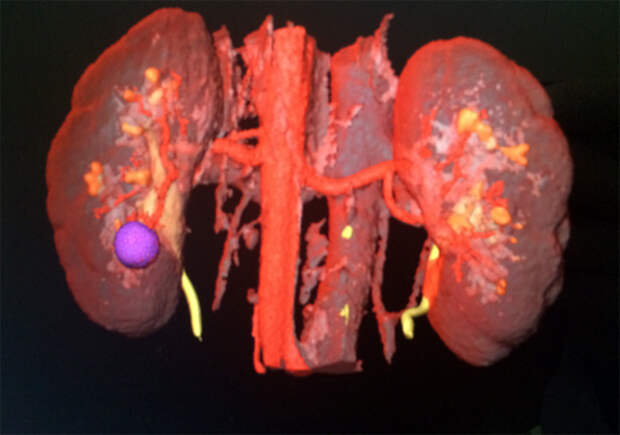 Сначала врачи получают 3D модель почки и точно видят место, где находится злокачественная опухоль (на рисунке она фиолетового цвета). Фото: из архива героя публикации