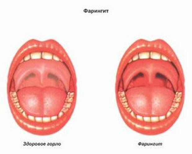 Одним из наиболее распространённых на сегодняшний день заболеваний горла является хронический фарингит.