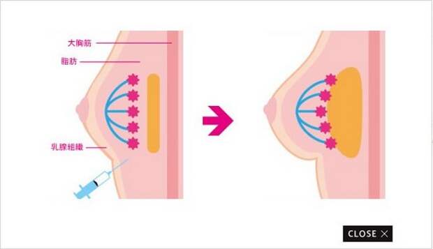 В Японии набирает популярность услуга увеличения груди на сутки