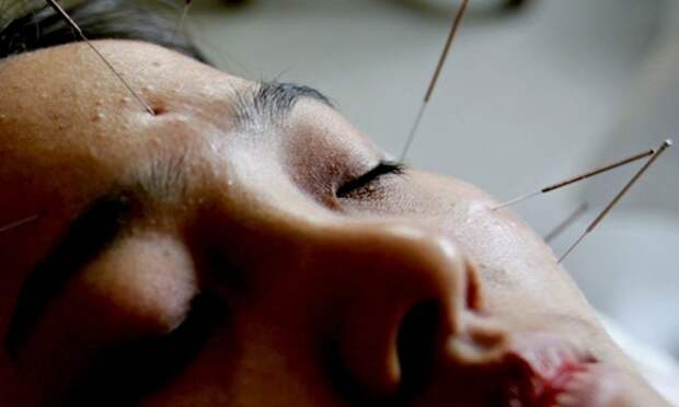 Acupuncture can be used to treat pain. 