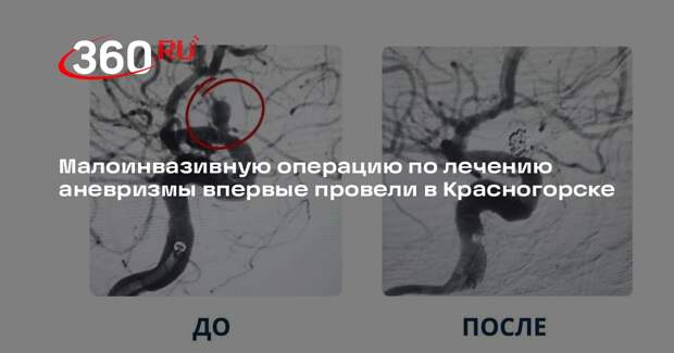Малоинвазивную операцию по лечению аневризмы впервые провели в Красногорске