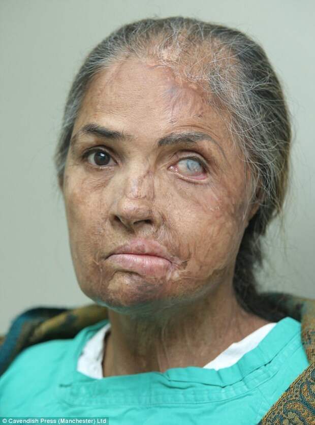 53-летняя Нияз Бано, владелица магазина из Пакистана, потеряла левый глаз после кислотного нападения во время скандала на свадьбе своей 16-летней дочери. врачи, жертвы насилия, кислота, кислотная атака, медицина, пластическая операция, трансплантация, фото