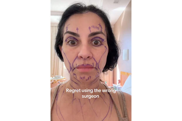 53-летняя женщина раскрыла неожиданные последствия неудачной пластики