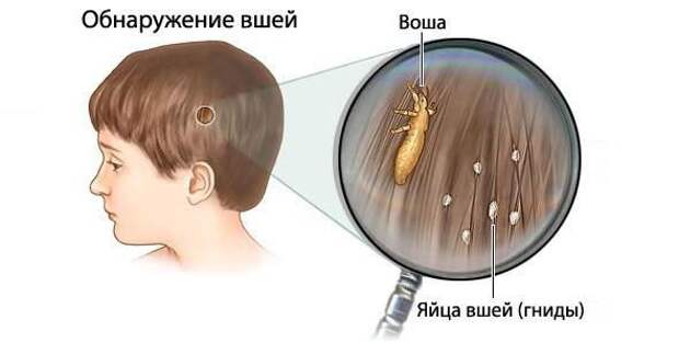 Обнаружение вшей и гнид на волосах.