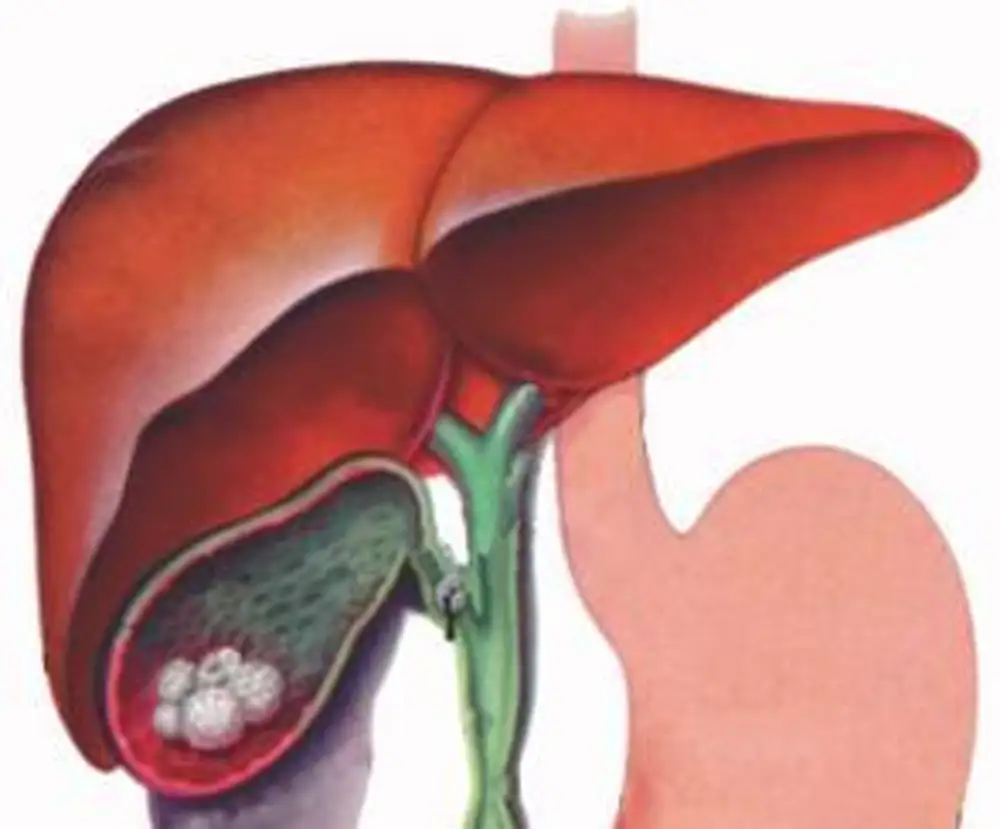 Конкремент в протоке желчного пузыря. Желчекаменная болезнь (жкб). Острый холецистит холедохолитиаз жкб. Желчекаменная болезнь холецистит. Конкремент в протоке желчного пузыря.