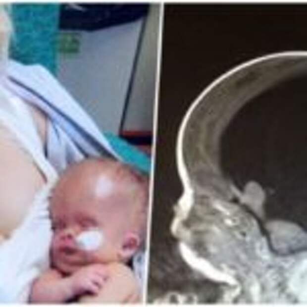Мальчик родившейся без головного мозга спустя 5 лет