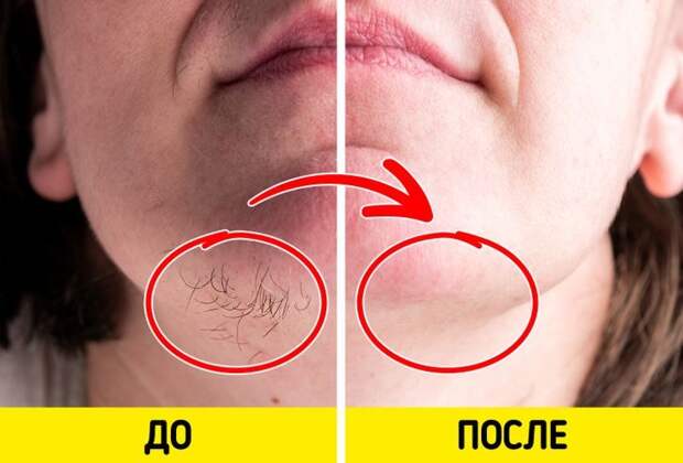 Ингредиенты, которые помогут избавиться от волос на лице в домашних условиях