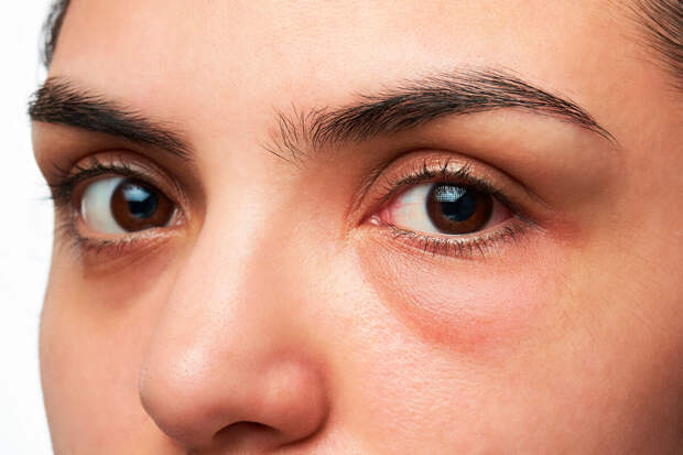 Врач Заручаева: теплый и рыхлый отек век с утра может указывать на болезнь почек