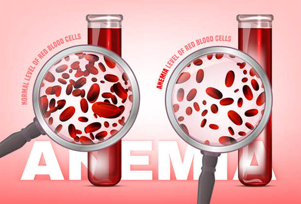 Анемия: Какие продукты нарушают всасывание железа