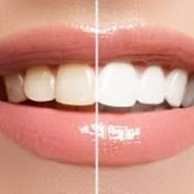 Отбеливание зубов и укрепление зубной эмали