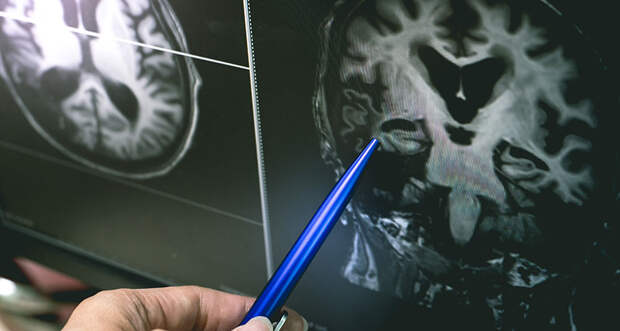 brain scan of cerebral atrophy