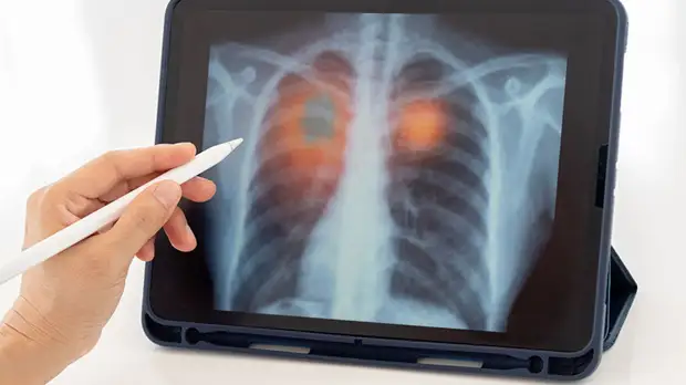 Иммунолог рассказала об отличиях обычной пневмонии от пневмонии при COVID-19