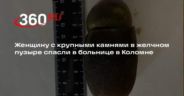 Женщину с крупными камнями в желчном пузыре спасли в больнице в Коломне