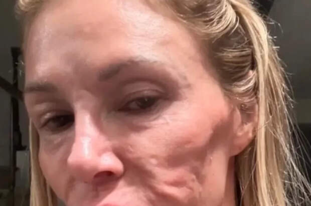 У звезды шоу «Настоящие домохозяйки Беверли-Хиллз» нашли паразитов в лице