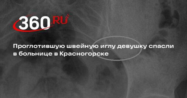 Проглотившую швейную иглу девушку спасли в больнице в Красногорске