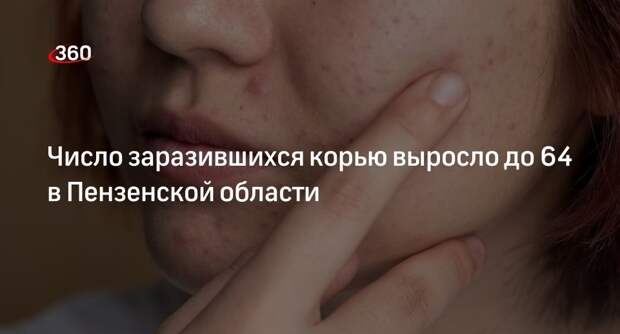 Минздрав Пензенской области: число заразившихся корью выросло до 64 в селе Средняя Елюзань