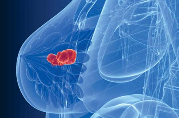 Что происходит на каждой стадии рака молочной железы?