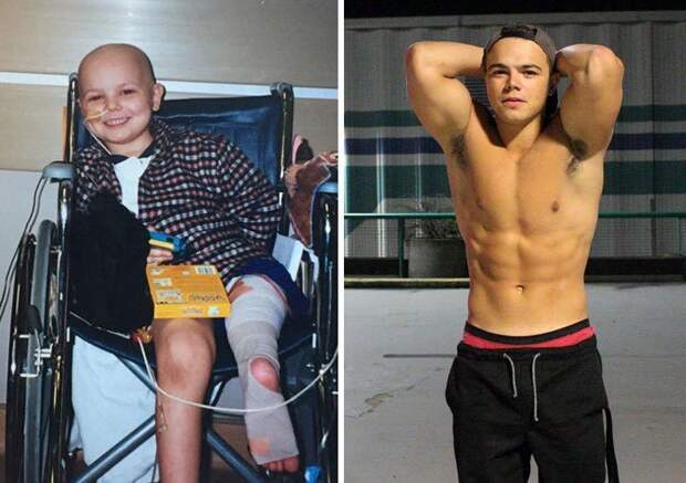 10. Этот парень покинул больницу 16 лет назад. Он сумел победить рак благодаря своей силе и смелости вдохновляющее, выжившие, до и после, заболевание, рак, сильные духом