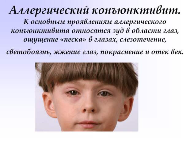 Аллергическая форма конъюнктивита у детей