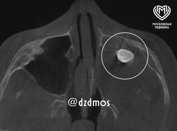 Московские врачи удалили выросший в носу у подростка зуб