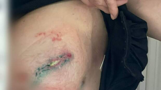 "Очнулась — груди нет". Жительница Барнаула судится с клиникой из-за неудачной операции