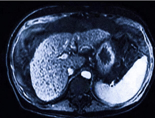 Исследование печени методом магнитно-резонансной томографии (МРТ)