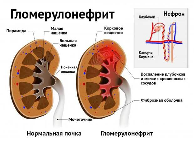 Гломерулонефрит: клиника, симптомы, диагностическое обследование, лечение, восстановление и последствия для организма