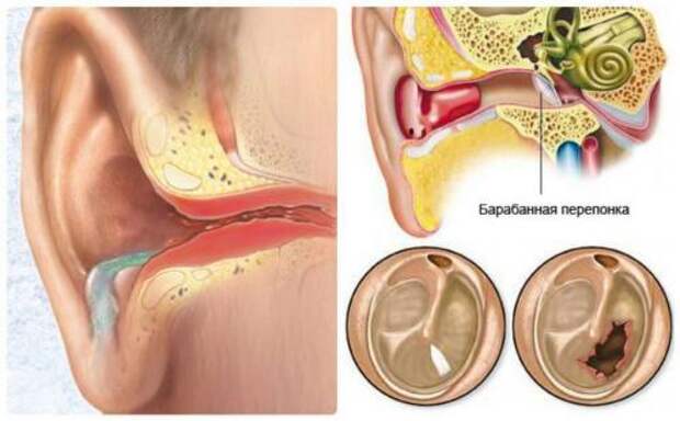 Лечение воспалительных заболеваний среднего уха. Краткое описание 04