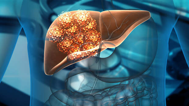 Тест-системы для ранней диагностики рака печени создают в России